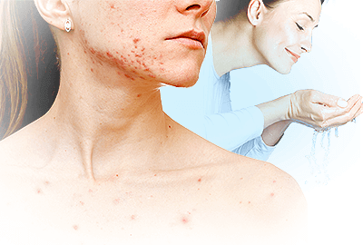 Acné en la menopausia