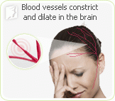 MIgraines Disorder