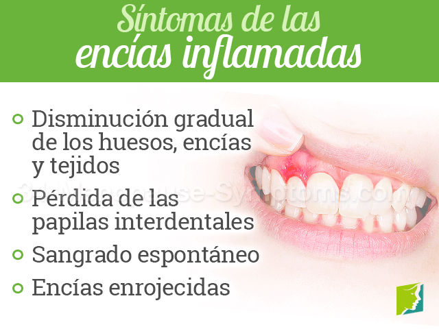 Síntomas de las encías inflamadas