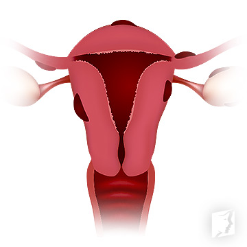 about endometriosis