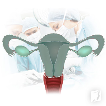 hysterectomy