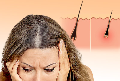 DHT and Hair Loss: All You Need to Know