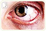 3 Helpful Tips to Prevent Eye Allergies