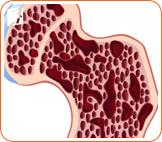 A Calcium-rich Diet to Prevent Osteoporosis1
