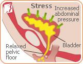 How to Deal with Stress Incontinence in Postmenopause2