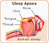 34MS-undstdng-slp-apnea2