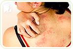 4 Common Triggers of Skin Allergies during Menopause