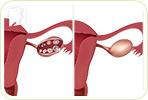 4 Hidden Causes of Early Menopause