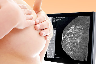 Breast Calcifications: Important to Know