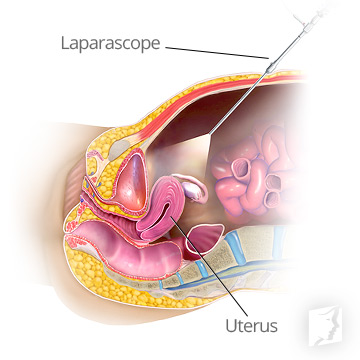 How the Procedure is Done - Laparoscopy