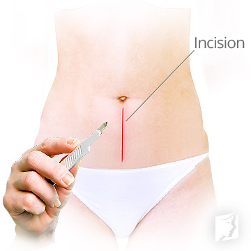 What is Surgical Menopause