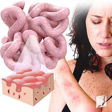 Celiac disease and dermatitis herpetiformis