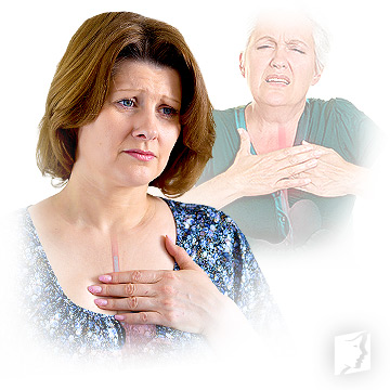Menopause and Acid Reflux/GERD | Menopause Now