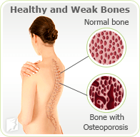 About Osteoporosis 1