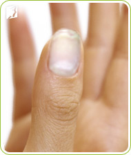 Brittle nails may be caused by different underlying conditions