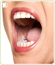 The most common gum problem is known as gingivitis and involves swollen gums