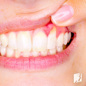 Receding gums