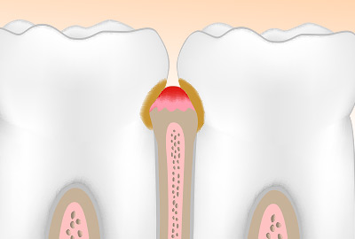 Severe Gingivitis & Gum Pain