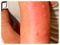 Rash is considered as a mild symptom of allergy