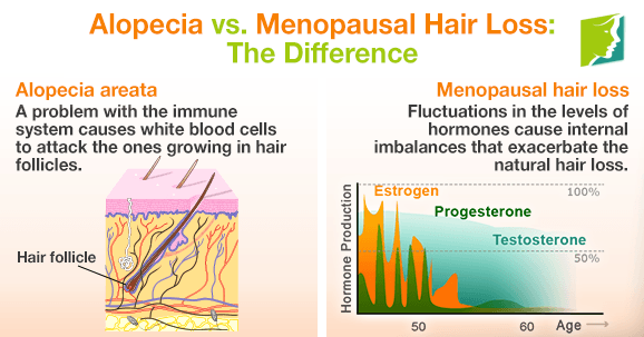 Alopecia vs. Menopausal Hair Loss: The Difference1