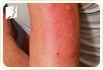 An Overview of Allergies That Can Cause Itchy Skin
