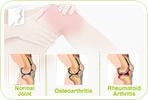 Arthritis and Joint Pain: The Difference