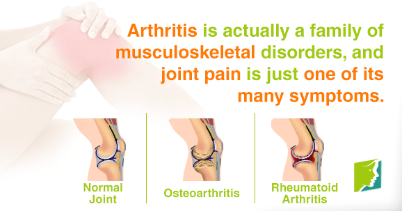 Arthritis is actually a family of musculoskeletal disorders, and joint pain is just on of its many symptoms.