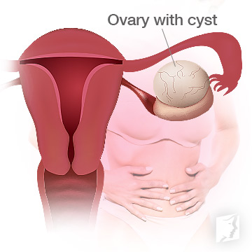 Ovarian Cysts during Menopause