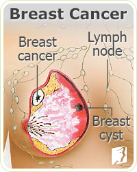 Breast Pain Causes