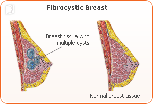 women and breast pain2