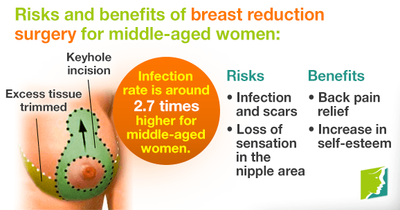 Breast Reduction Surgery for Middle-aged Women