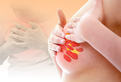 Breast Swelling and Tenderness