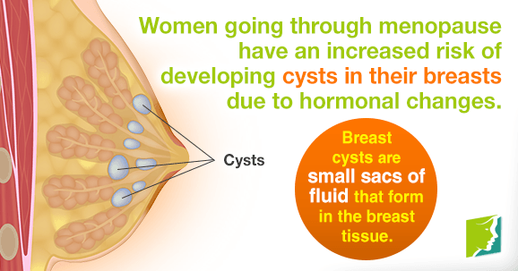 Breast cysts are small sacs of fluid that form in the breast tissue