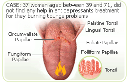 burning tongue antidepressants