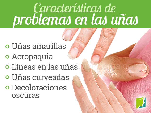 Características de problemas en las uñas