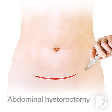Abdominal Hysterectomy