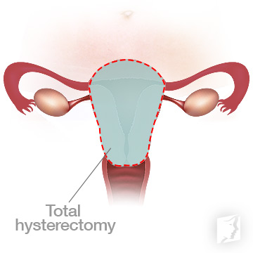 Hysterectomy Types