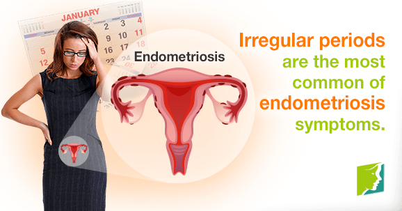 Irregular periods are a symptom of endometriosis. 