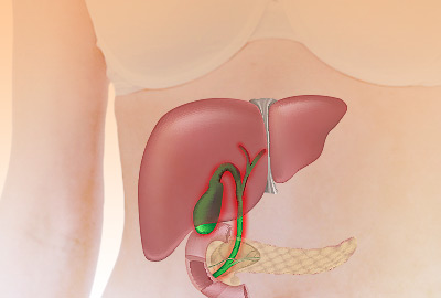 Can Gallstones Cause Weight Gain?
