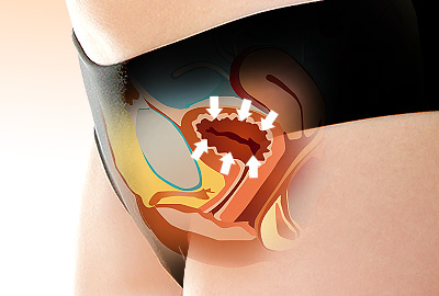 Causes of Incontinence in Women