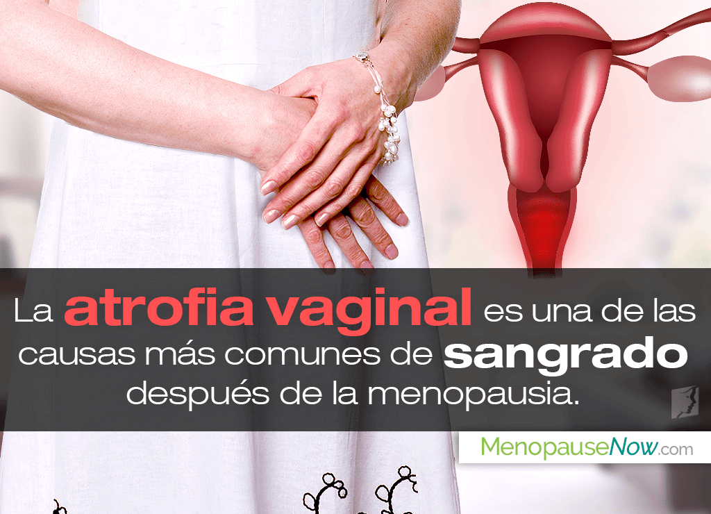 Causas De Sangrado Después De La Menopausia Menopause Now