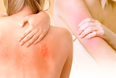 Symptoms of Itchy Skin