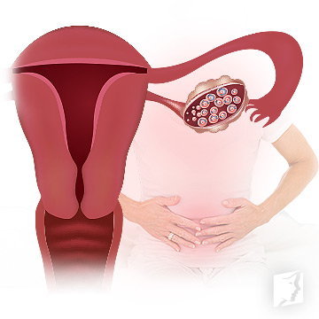 PCOS and Menopause