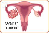 does-risk-of-ovarian-cancer-increase-post-menopause-2