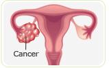 Does Risk of Ovarian Cancer Increase during Postmenopause?
