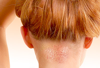 Hair Transplant for Women FAQs