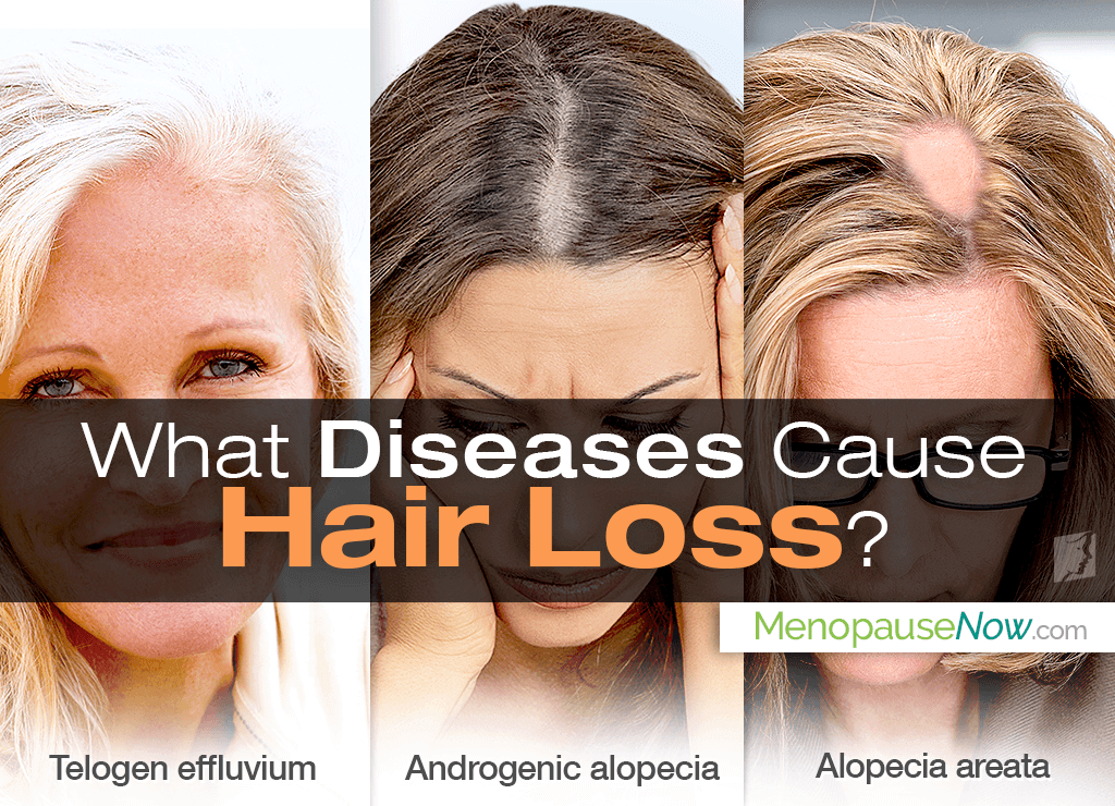 Hair Diseases and Hair Loss | Menopause Now