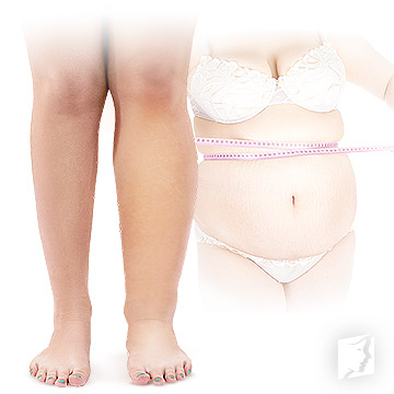 symptoms of water retention