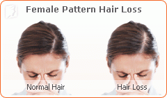 Increased Hair Loss in Women1