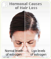 Hormonal causes for hair loss